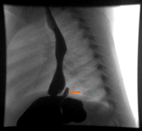 Thoracotomy with excision of duplication cyst Medical Billing …