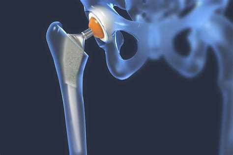Thousands got Exactech knee or hip replacements. Then, patients say, the parts began to fail