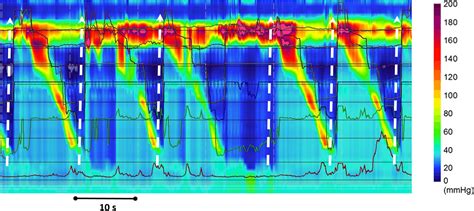 Thread ka ilaj.  Inability to belch or &ldquo;burp&rdquo; (R-CPD) occurs when the cricopharyngeus ...