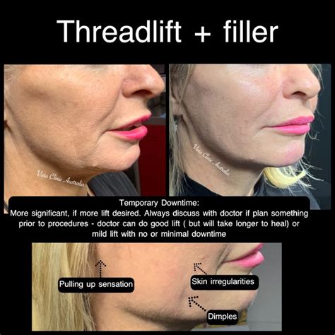 Thread lift downtime.  Here&rsquo;s what to expect from results, recover...