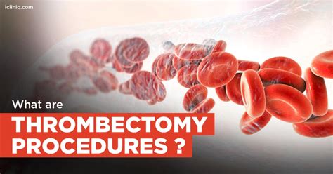 Thrombectomy Procedures: What Are They? - iCliniq