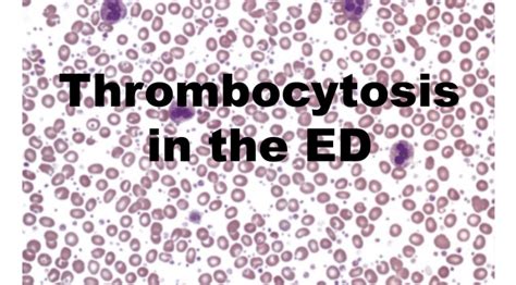 Thrombocytosis in the ED emdocs