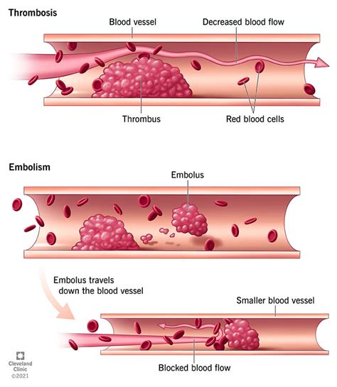 Thrombosed - definition of thrombosed by The Free …