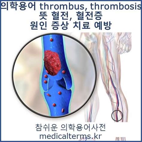 Thrombosis 뜻
