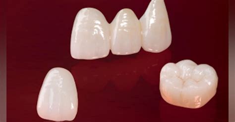 Thursday Troubleshooter: Different codes for zirconia crowns vs. e.max