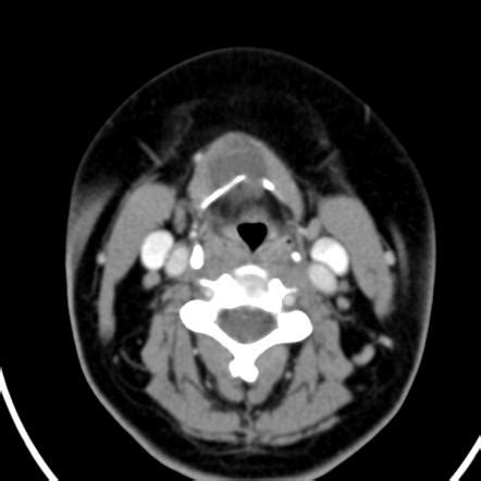 Thyroglossal duct cyst Radiology Reference Article - Radiopaedia