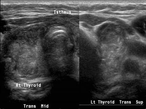 Thyroid bed nodule.  What&rsquo;s the treatment for a thyroid nodule? Even a beni...