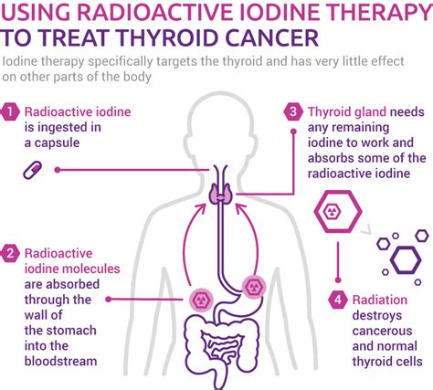 Thyroid cancer treatment iodine. .  <a href=https://dispatchcenter.space/n6brfj3p/index...