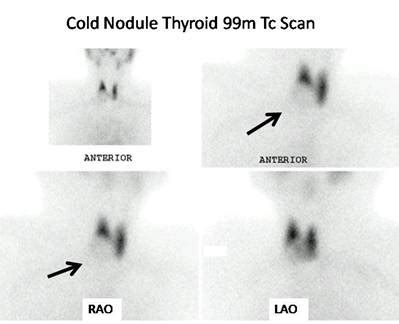 Thyroid cold nodule.  Connect with a real person when you need help.  ...