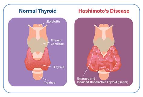 Thyroid disease causes.  (Examples: Hashimoto&rsquo;s thyroiditis or atrophic thyroidit...