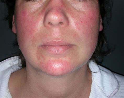 Thyroid rashes photos. Hives (urticaria) are the second most common type of drug rash. This type of rash consists of small, pale red bumps that can connect and form larger patches. They can become very itchy. Possible ... 