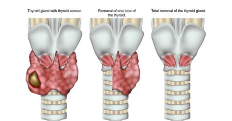 Thyroidectomy Definition & Meaning - Merriam-Webster