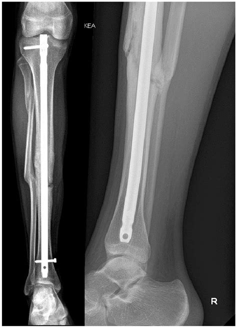 Tibia - Fracture - Intramedullary Nailing with the Expert Tibial Nail ...