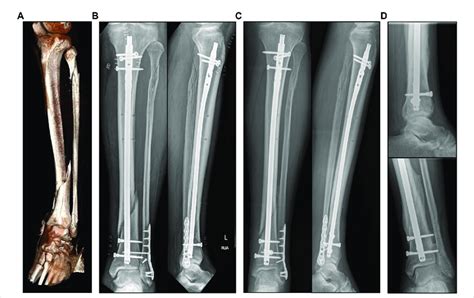 Tibia and fibula diaphyseal fractures Musculoskeletal …