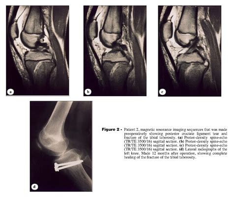 Tibial tuberosity avulsion fracture combined with meniscal tear