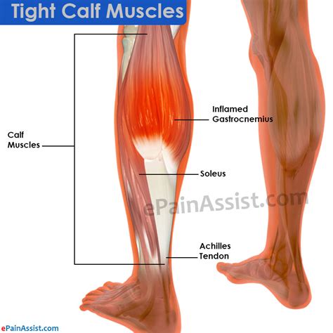 Tight Calf Muscles in Runners Causes and Treatment