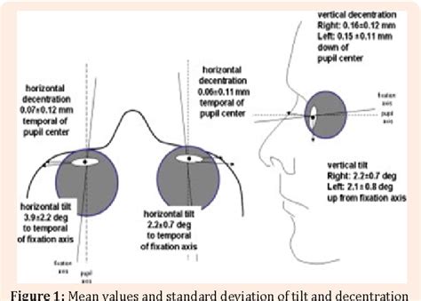 Tilt and decentration of intraocular lenses-a brief review