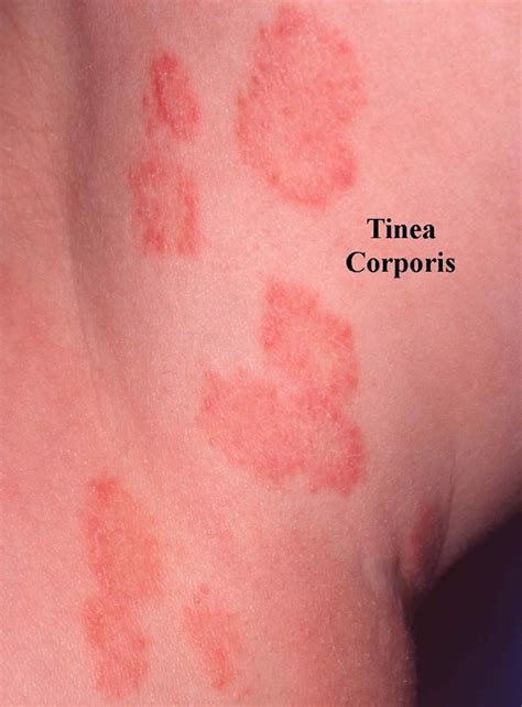 Tinea Onlyfans Leaked +18 240 Photos
