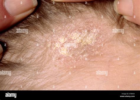 Tinea - an overview - Primary Care Dermatology Society