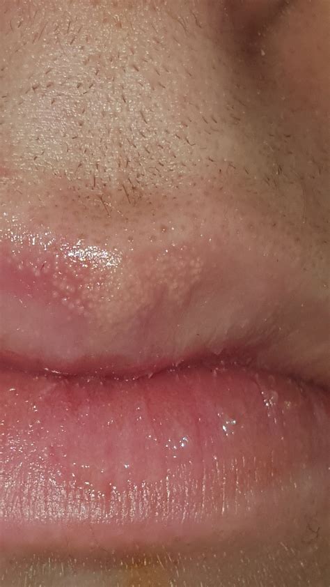 After a session of lip fillers, you can expect your side effects to include the following: Bruising. Swelling. Pain and tenderness. Redness. Small lumps. These common side effects typically keep to the area of the injection site, in this case, the lips, and will subside after a few days.. 