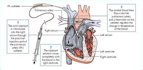 Tip The Cardiac Output Method