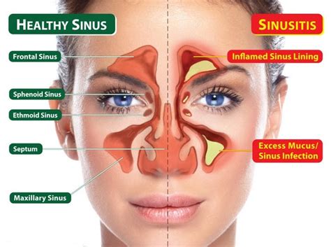 Tips for treating chronic sinus infections