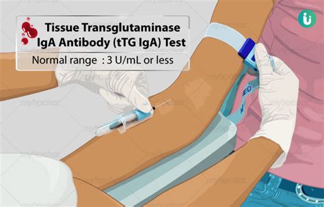 Tissue Transglutaminase (tTG) IgG Antibody - Children