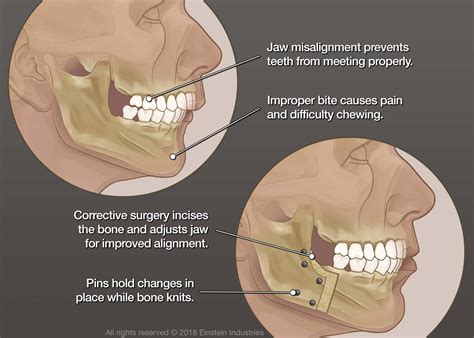 Tmj surgery cost. Things To Know About Tmj surgery cost. 