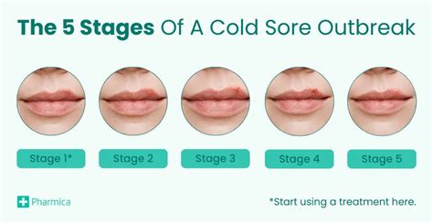 Tml cold sores treatment. .  <a href=https://dispatchcenter.space/dgaf5/...