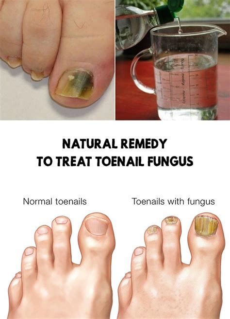 Toe fungus icd 10. Unspecified open wound of unspecified toe(s) with damage to nail, initial encounter. Unsp open wound of unsp toe(s) w damage to nail, ... Pneumonia due to fungus. ICD-10-CM Diagnosis Code J16.8. 
