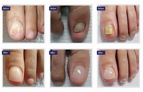 Toenail removal healing stages pictures. Treatments include: Oral antifungals. The doctor may give you a pill to kill fungus in your whole body. This is usually the best way to get rid of a nail infection. Treatment may last 2 months for ... 