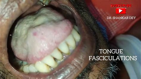 Tongue Fasciculations NEJM - YouTube