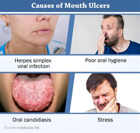 Tongue Ulcer: Definition, Reason, Symptoms and Treatment