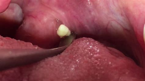 Tonsil stone. 6.18K subscribers. Subscribe. Share. 1.3M views 4 years ago. how to remove Tonsil Stones video for science We do NOT own all the materials as well as footages used in this...