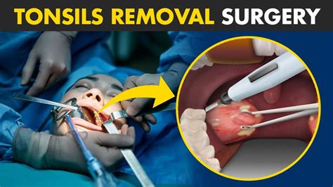 Tonsillectomy (Tonsil Removal) Surgery cost in New Delhi - Health …