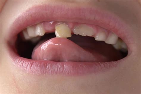 Tooth On The Loose
