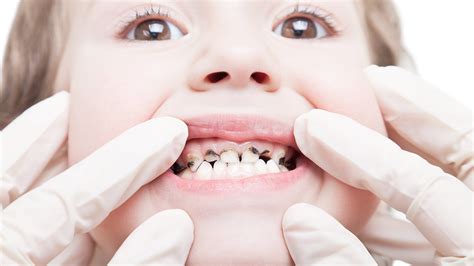 Tooth decay most common chronic disease in children