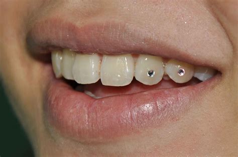 Tooth gem near me. Tooth gems are genuine Swarovski or 18k solid gold crystals applied to your teeth with dental components. They are semi-permanent, non-damaging, and can be removed at … 
