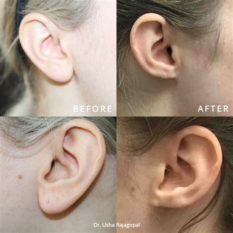 Top 10 Best Earlobe Repair in San Francisco, CA - Yelp