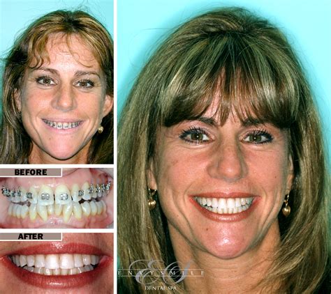 Top 10 Best Orthodontist in Ballston Spa, NY Braces and …