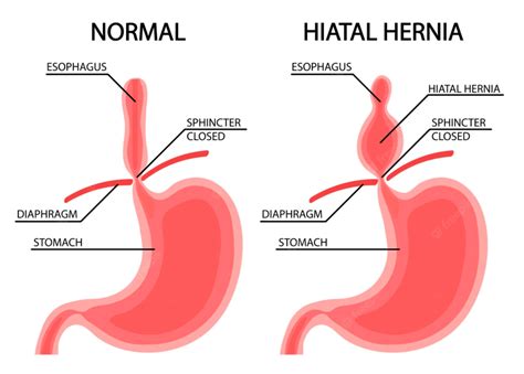 Top 10 Things You Should Not Do For Hiatal Hernia