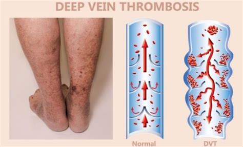 Top specialists for thrombophlebitis in Cannock TopDoctors