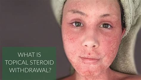 Topical steroid withdraw. Things To Know About Topical steroid withdraw. 