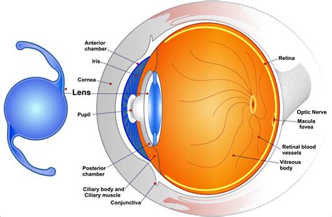 Toric IOL For Astigmatism Correction - All About Vision