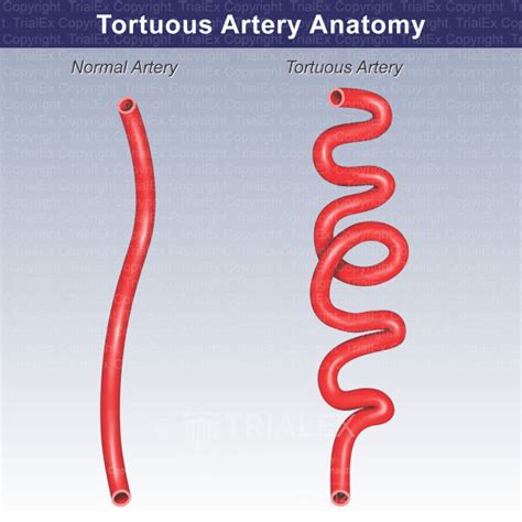 Tortuous vessels meaning.  This condition can have significant implications for...