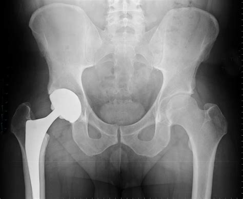 Total Hip Replacement Surgery - Cedars-Sinai Kerlan-Jobe Institute