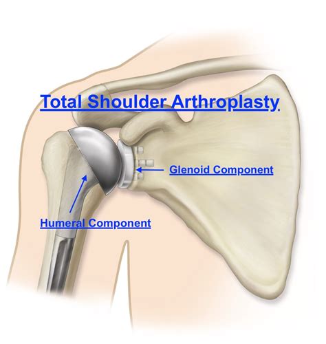 Total Shoulder Replacement with Dr. Christopher …