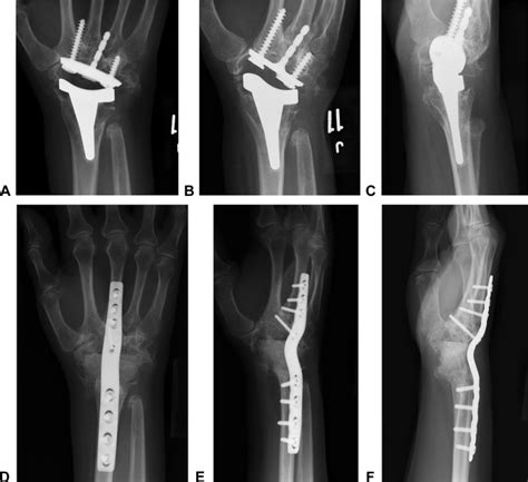 Total Wrist Arthrodesis and Total Wrist Arthroplasty