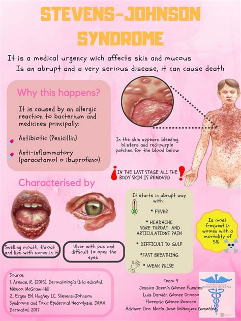 Toxic Epidermal Necrolysis Syndrome (TEN) & Stevens-Johnson Syndrome …