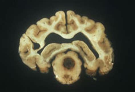 Toxoplasmosis - CFSPH